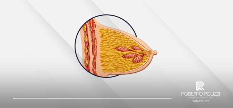 Mamas tuberosas: Saiba como a cirurgia plástica pode ajudar