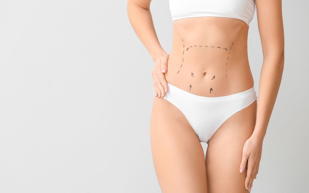 Abdominoplastia: cicatriz e recuperação!